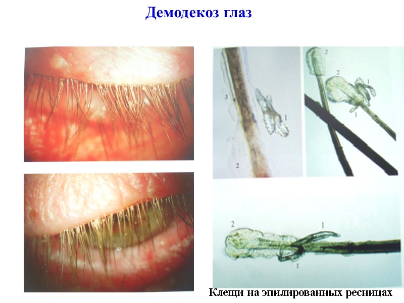 Демодекоз глаз Клещи на эпилированных ресницах